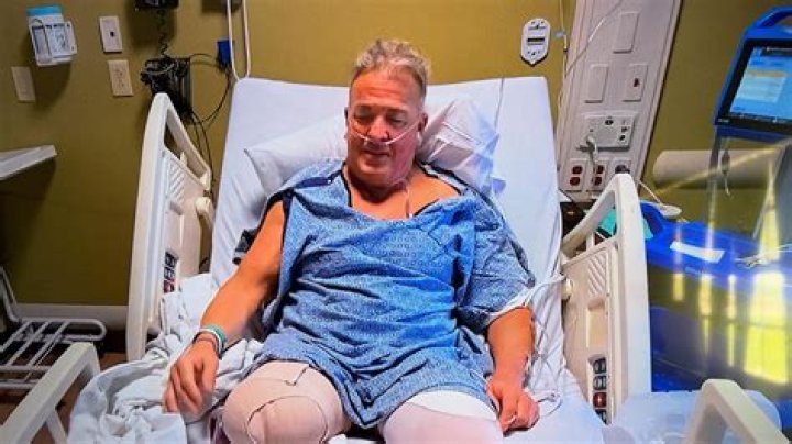 Mason Leg Amputated Surgery: Understanding the Procedure and Recovery