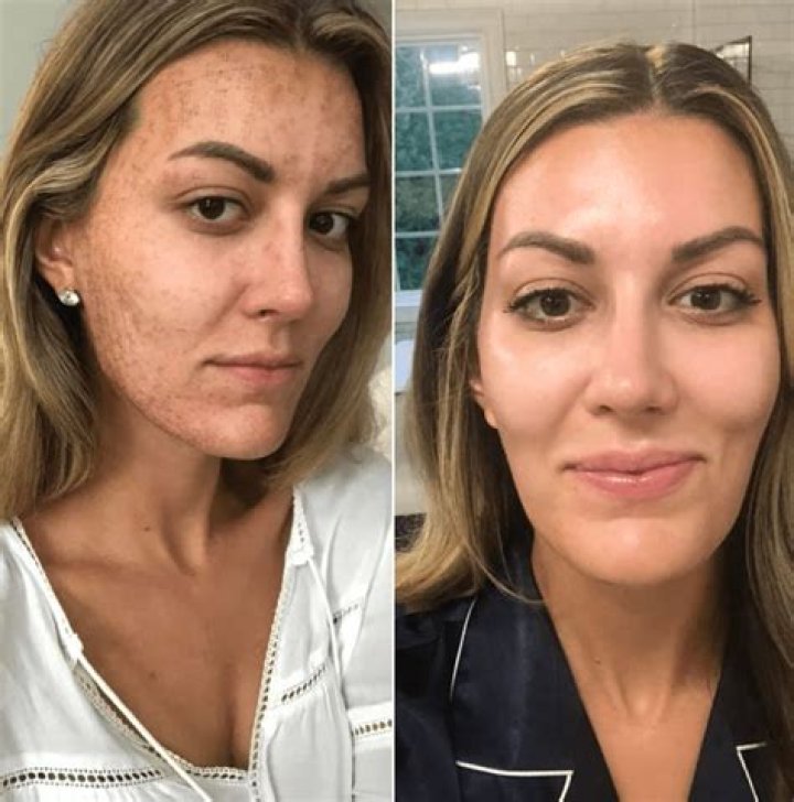 Microneedling Ruined My Skin: A Cautionary Tale
